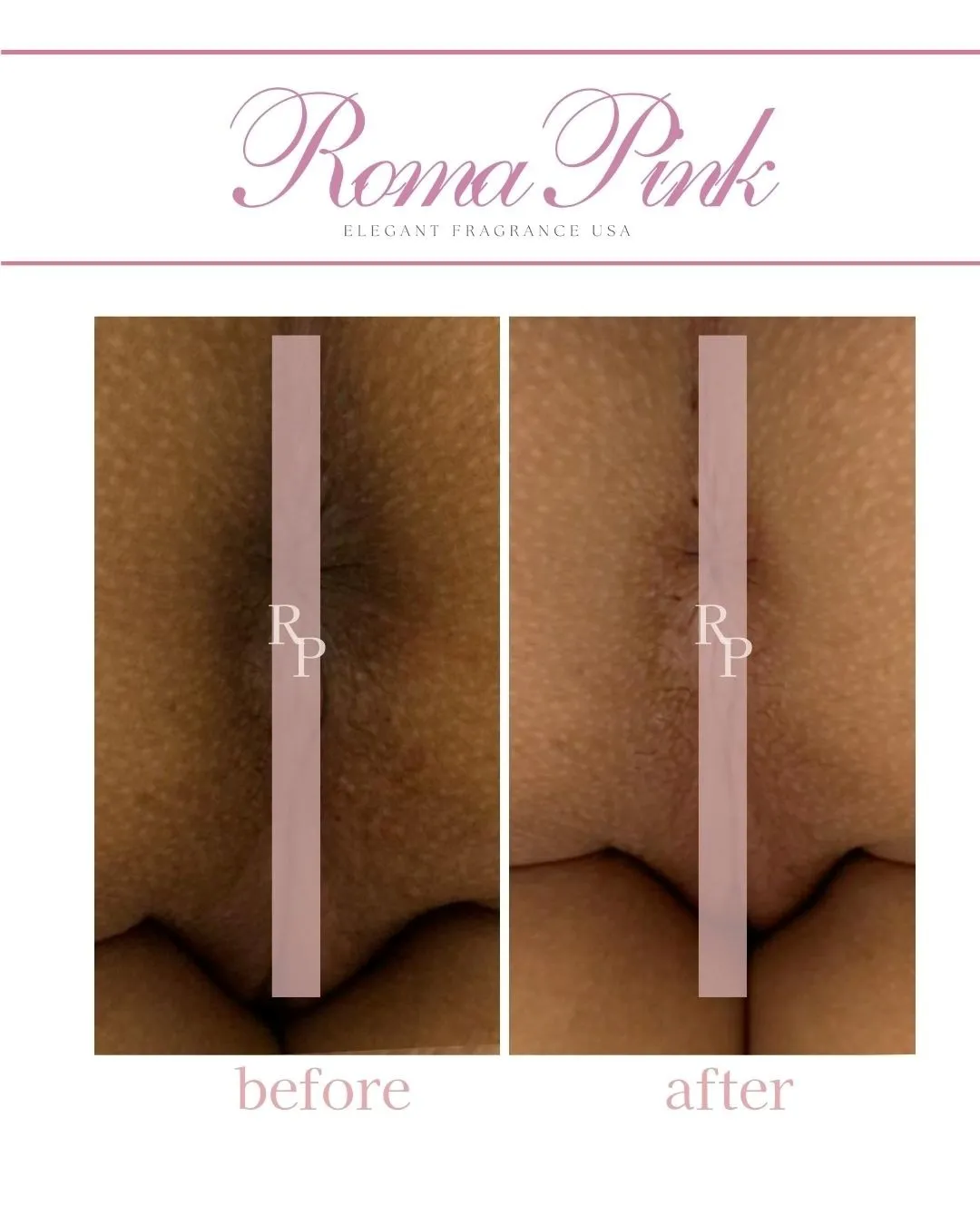ローマピンク名古屋正規導入店/ローマピンクで黒ずみ改善/デリケートゾーン黒ずみ改善＃バスト黒ずみ改善/ローマピンクビフォーアフター