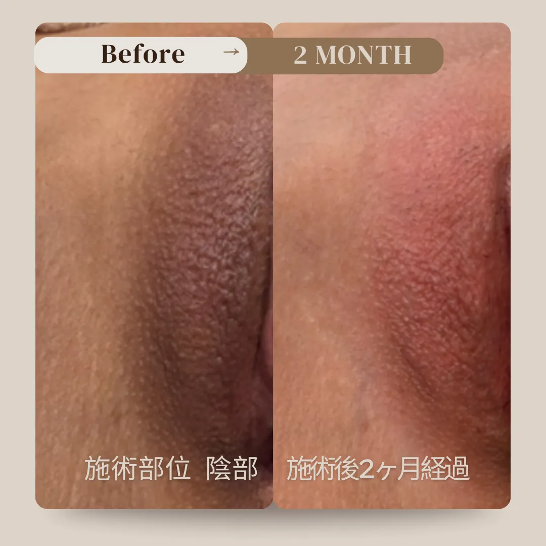 ローマピンク名古屋正規導入店！モニター40％off