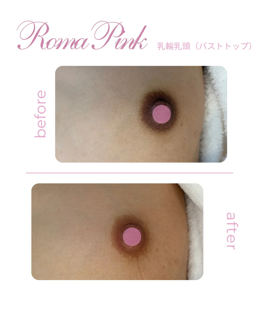 ローマピンク乳輪乳頭|モニターF様ビフォーアフター