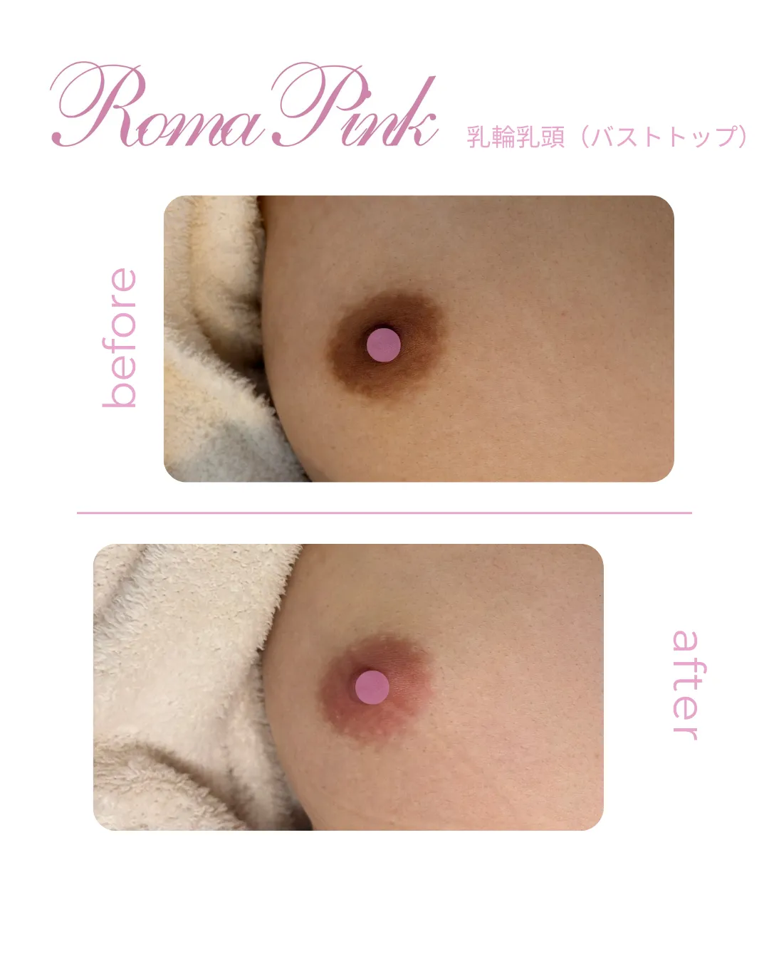 ローマピンク乳輪乳頭のビフォーアフター